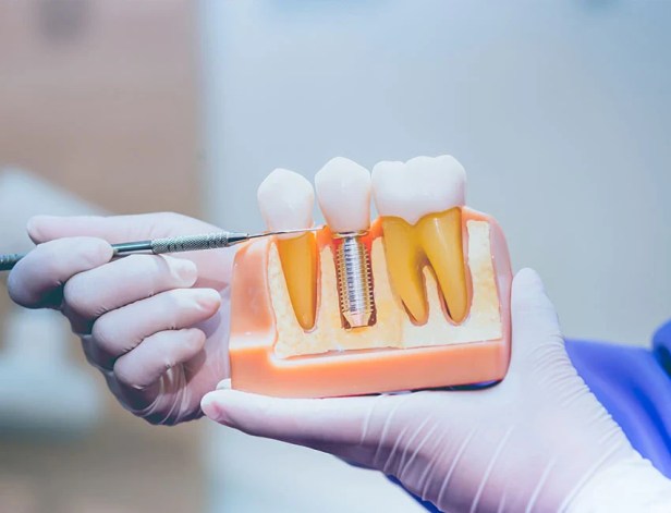Dental Implants in Fullerton: A Permanent Solution for a Stronger, Healthier&nbsp;Smile